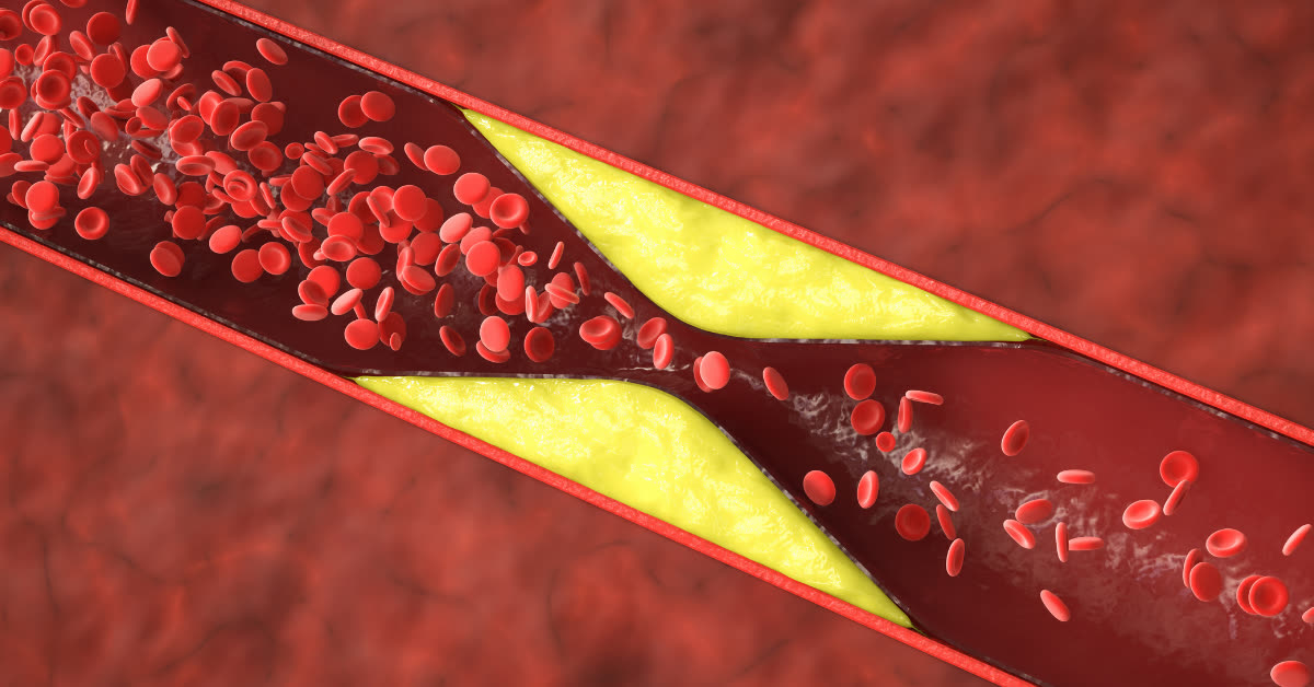 Querschnitt einer Arterie mit Ablagerungen in der Gefaesswand, die den Blutfluss verengen